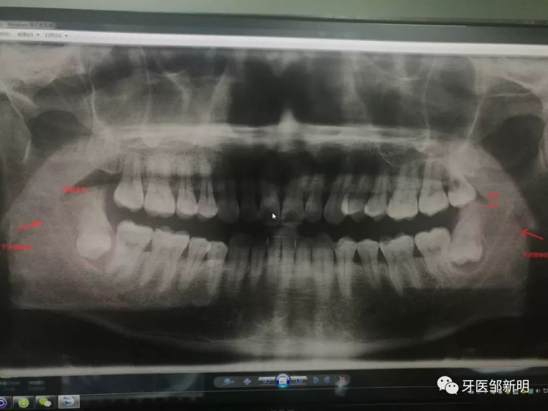 药经验吃智齿冠周炎能好吗_药经验吃智齿冠周炎可以吗_智齿冠周炎吃什么药 经验