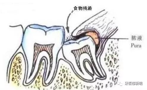 智齿冠周炎吃什么药 经验_药经验吃智齿冠周炎可以吗_药经验吃智齿冠周炎能好吗