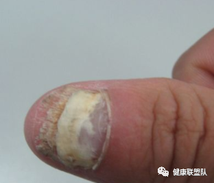 灰指甲的治疗土方法 6个土方法治疗灰指甲!(图3) 土法治疗灰指甲办法有哪些_土方甲治疗法灰指甲怎么治_土方法治疗灰指甲