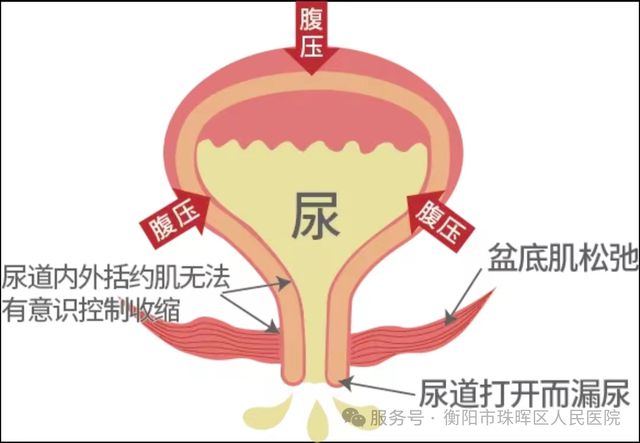 女性尿失禁原因_女尿失禁什么原因有三_女尿失禁什么原因引起的