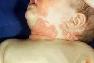 孕妇胎毒一般长在哪里_孕妈胎毒_孕妇胎毒是什么样子
