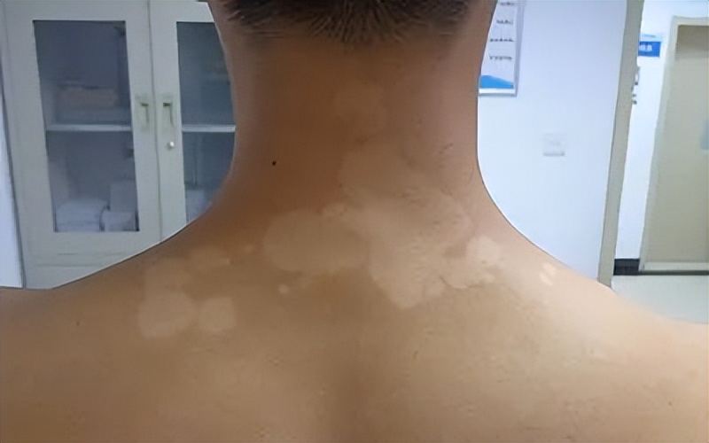 白色儿童糠疹图片_白色儿童糠疹用什么药_儿童 白色糠疹