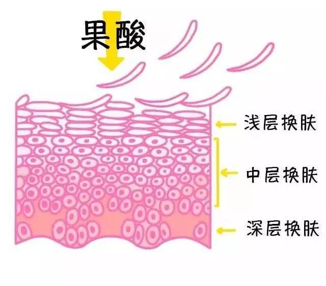 光子嫩肤祛痘价格_光子嫩肤体验分享_果酸焕肤配合光子嫩肤