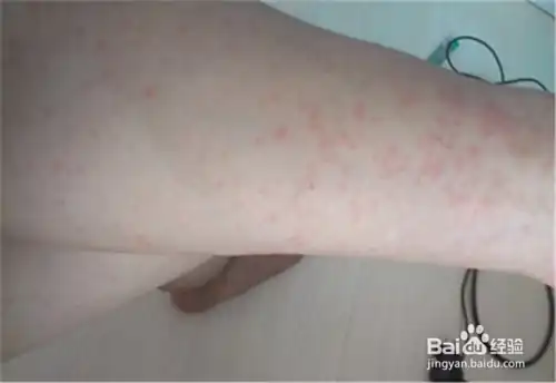 身体全身都长湿疹怎么办